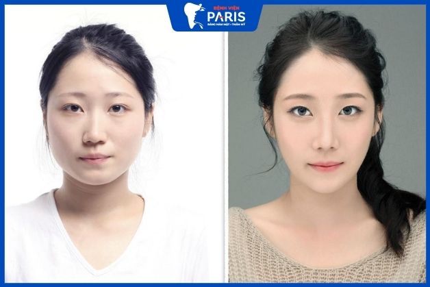Gọt mặt bao lâu hết sưng, Đau, Đẹp,đi làm bình thường?
