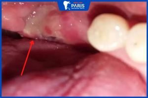 Màng trắng sau khi nhổ răng: bị nhiễm trùng hay đang lành thương?