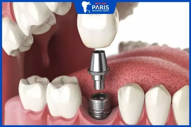 Trồng xương răng nhân tạo implant cho răng hàm bị mất