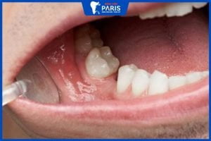 Mất răng hàm có bị hóp má không? 3 Giải pháp phục hình răng hàm
