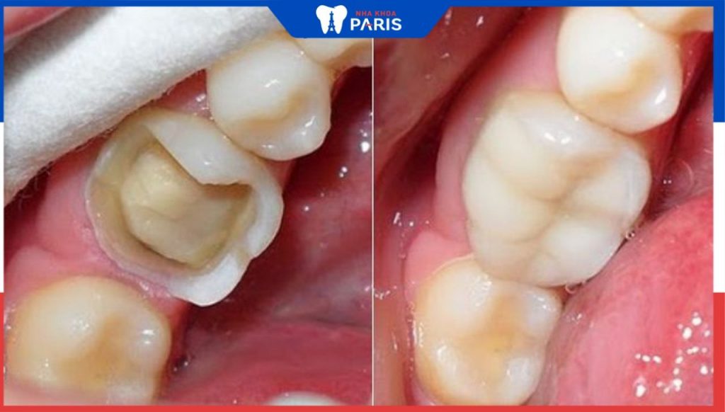 Miếng trám răng bị vỡ, Rớt, Hỏng thế nào – Cách giải quyết hiệu quả