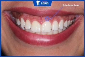 Người cười hở lợi sướng hay khổ?Là tướng xấu hay tốt?