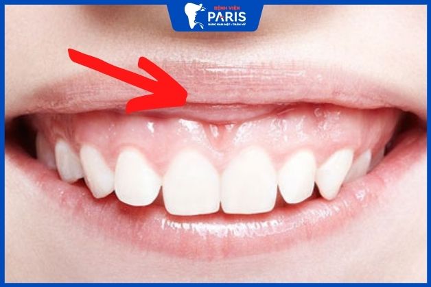 Bị cường cơ môi (hình minh họa) người cười hở lợi sướng hay khổ