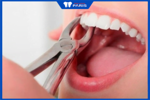 Niềng răng có phải nhổ răng không? Số lượng răng phải nhổ