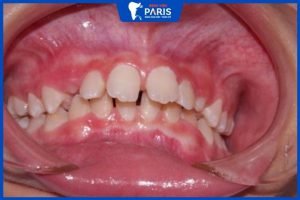 Bé bị hô hàm trên: 8 Điều cần biết khi phát hiện bé bị hô hàm