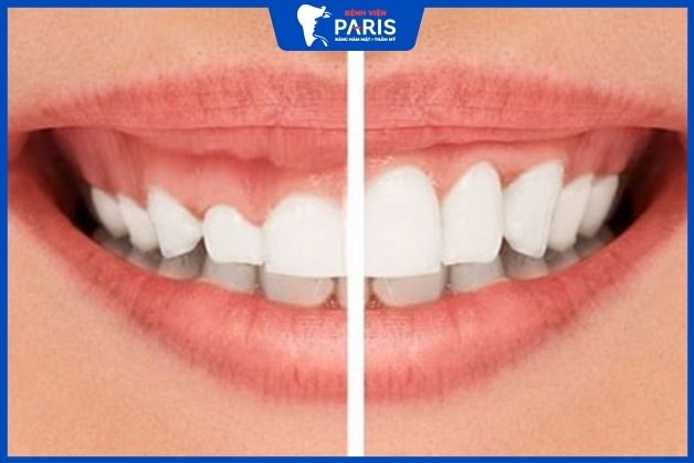 Cắt lợi là giải pháp giúp khắc phục tình trạng cười hở lợi