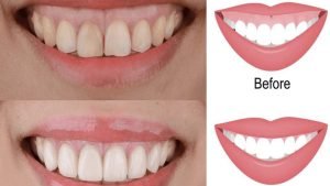Giải đáp: Cắt lợi ở bệnh viện răng hàm mặt có đau không