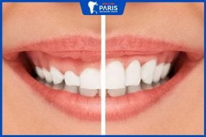 Phẫu thuật Cắt nướu cười hở lợi – giải pháp cho nụ cười rạng rỡ