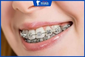 Chi phí niềng răng hô nhẹ tại Bệnh viện răng hàm mặt paris