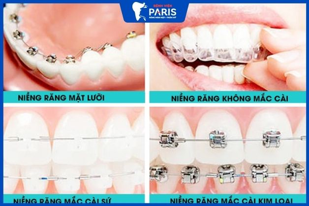 Chi phí niềng răng hô nhẹ tùy thuộc vào phương pháp chỉnh nha áp dụng