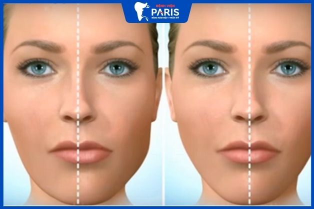 Chỉnh hàm lệch – Giải pháp cho tình trạng sai khớp cắn
