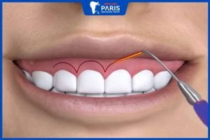 Chữa cười hở lợi bằng laser – giải pháp cho nụ cười đẹp
