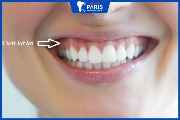 Cười hở lợi khiến nhiều người tự ti khi giao tiếp