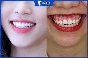 Cười hở lợi có ảnh hưởng gì không? 3 Phương pháp điều trị hiệu quả