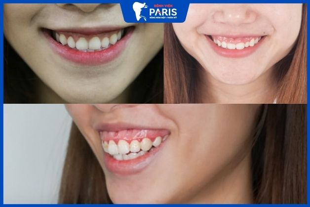 Các mức độ cười hở lợi