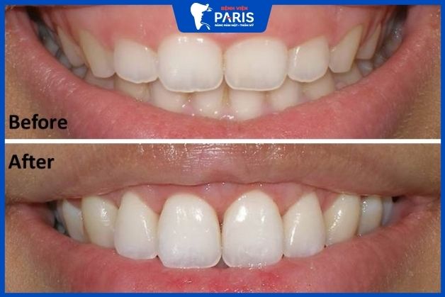 Cắt nướu làm dài thân răng