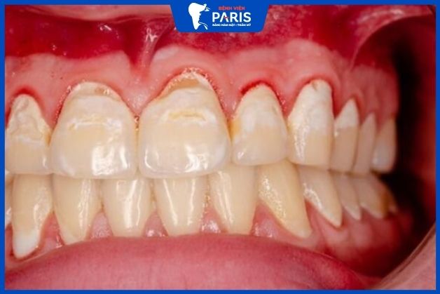 Lợi sưng đỏ sau phẫu thuật cắt lợi
