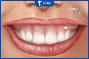 Cười hở lợi có chữa được không? 2 Cách khắc phục hiệu quả