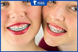 Cười hở lợi có niềng răng được không – 3 Phương pháp hiệu quả