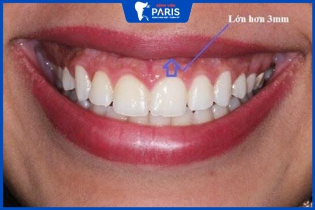 Nướu lộ ra quá 3mm được gọi là cười bị hở lợi