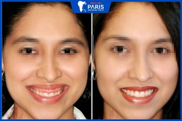 Phẫu thuật hàm chữa triệt để nụ cười kém duyên cười hở lợi tướng số nữ