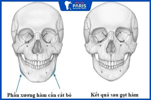 Gọt làm là kỹ thuật cắt nhỏ xương hàm