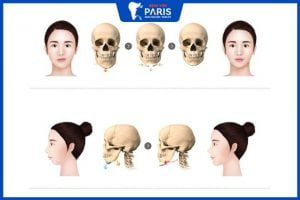 Gọt hàm có giảm tuổi thọ không, sức khỏe có yếu đi không?