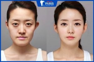 Gọt hàm xong ăn gì? Chế độ dinh dưỡng tiêu chuẩn hậu gọt hàm