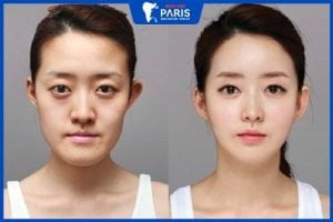 Gọt mặt an toàn: Gọt mặt có đau không? Nguy hiểm không