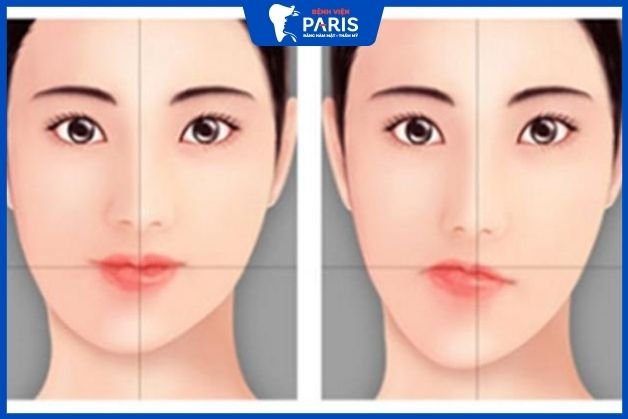 Cằm lệch sau khi phẫu thuật gọt mặt