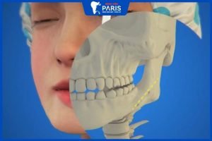 Gọt xương hàm có nguy hiểm không? Có nên gọt hàm không