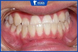 Hàm răng bị móm: 4 nguyên nhân, 3 cách khắc phục