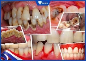 Cạo vôi răng giá bao nhiêu? Bảng chi phí cạo vôi răng 2022