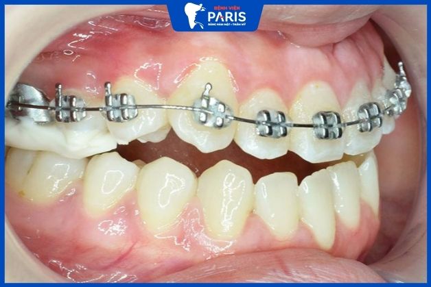 Niềng răng 1 hàm áp dụng được với những người có mức độ sai lệch răng, hàm nhẹ