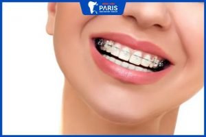 Niềng răng 1 hàm có được không? Chi phí hết bao nhiêu?