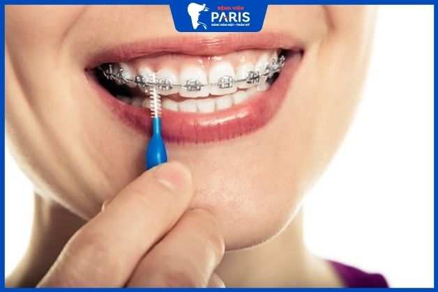Niềng răng 1 hàm trên phù hợp với những người bị hô, móm nhẹ