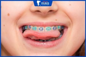 Niềng răng cho trẻ: Giá bao nhiêu, có đau không, ở đâu tốt?