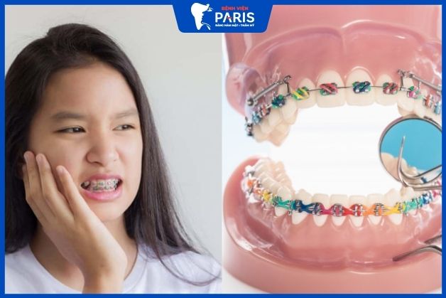 Niềng răng có thể gây ra cảm giác đau nhức