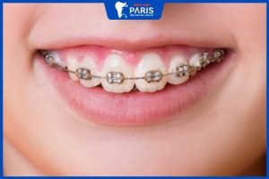 Giải đáp thắc mắc: Niềng răng hô nhẹ có phải nhổ răng không