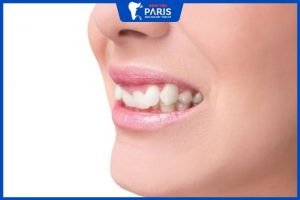 Niềng răng khểnh có khó không? mất bao lâu và hết bao nhiêu tiền