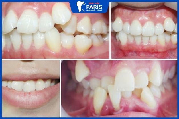 Niềng răng không mắc cài bao nhiêu tiền phụ thuộc vào tình trạng của răng