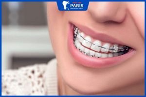 Niềng răng khớp cắn ngược – giải pháp tối ưu để sở hữu hàm răng đẹp