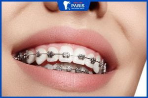 Niềng răng mắc cài kim loại – phương pháp được ưa chuộng nhất