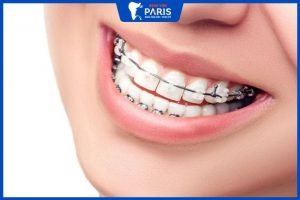 Niềng răng mắc cài pha lê: có tốt không? Giá bao nhiêu