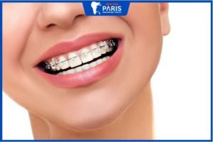 Niềng răng mắc cài sứ có đau không? Chi phí hết bao nhiêu?