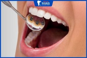 Niềng răng mặt trong có hiệu quả không? 4 Điều cần biết trước khi niềng
