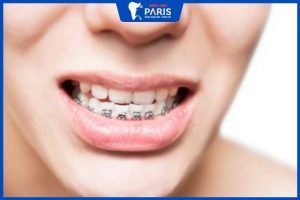 Niềng răng móm hàm dưới – giải pháp giúp gương mặt cân đối, hài hòa