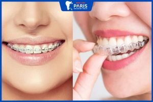 Niềng răng ở bệnh viện răng hàm mặt có hiệu quả không?