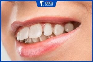 Phẫu thuật chỉnh hàm hô bao nhiêu tiền? Bảng giá mới nhất