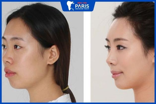 Trước và sau can thiệp xương hàm chỉnh hô